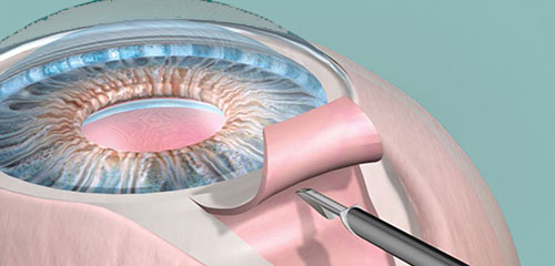 Cirurgia para glaucoma (trabeculectomia)