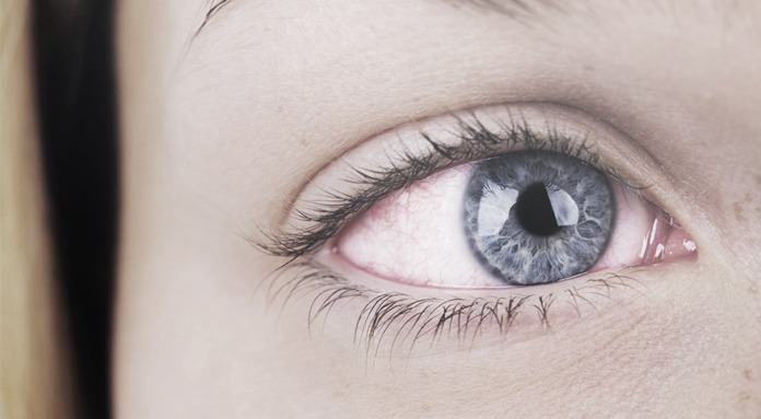 Vermelhidão nos olhos - Visão Hospital Oftalmológico
