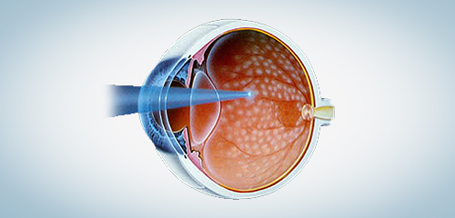 Fotocoagulação a laser da retina