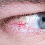 Glaucoma de ângulo fechado: entenda a doença