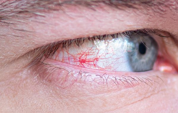 Glaucoma de ângulo fechado: entenda a doença