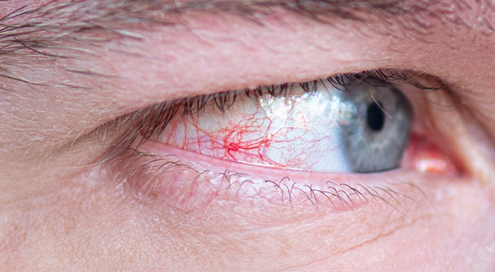 Glaucoma de ângulo fechado: entenda a doença