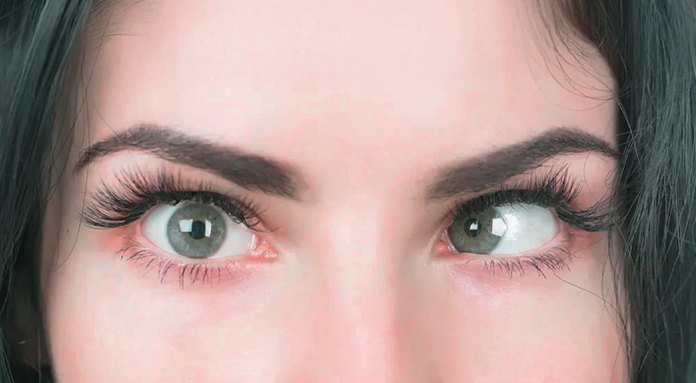 Você sabe o que é estrabismo torcional?