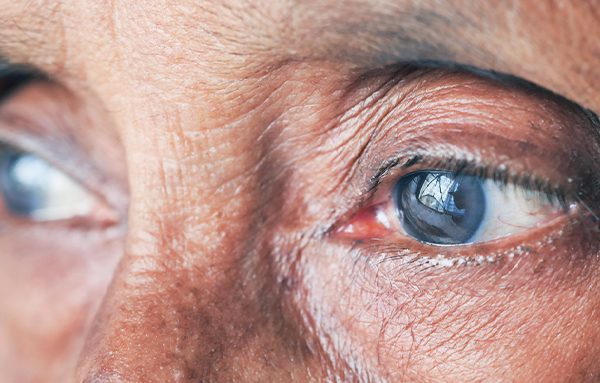 Qual a diferença entre glaucoma de ângulo aberto e glaucoma de ângulo fechado?