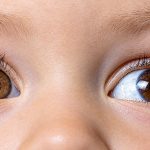 O que é o retinoblastoma? Aprenda a reconhecer os primeiros sinais em crianças