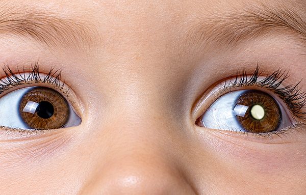 O que é o retinoblastoma? Aprenda a reconhecer os primeiros sinais em crianças
